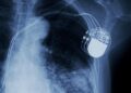 An X-ray of an implantable pacemakers with sensor leads attached to a low noise amplifier