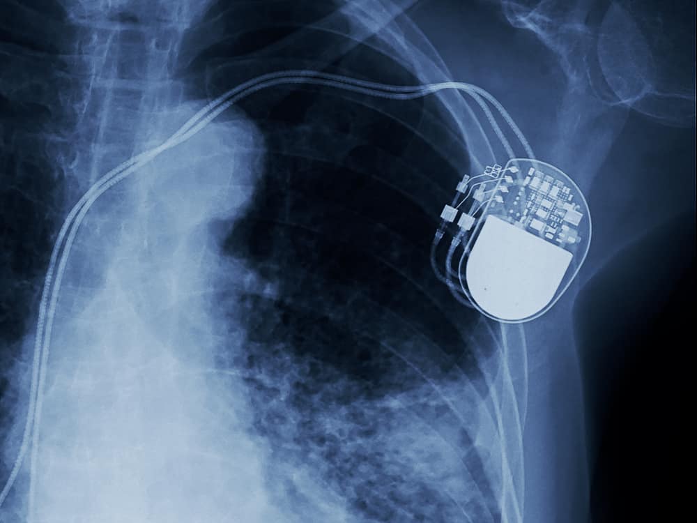 An X-ray of an implantable pacemakers with sensor leads attached to a low noise amplifier